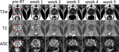 Quantitative MRI Changes During Weekly Ultra-Hypofractionated Prostate Cancer Radiotherapy With Integrated Boost